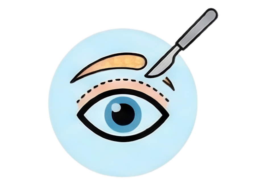 Blepharoplasty