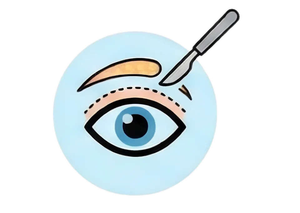 Blepharoplasty
