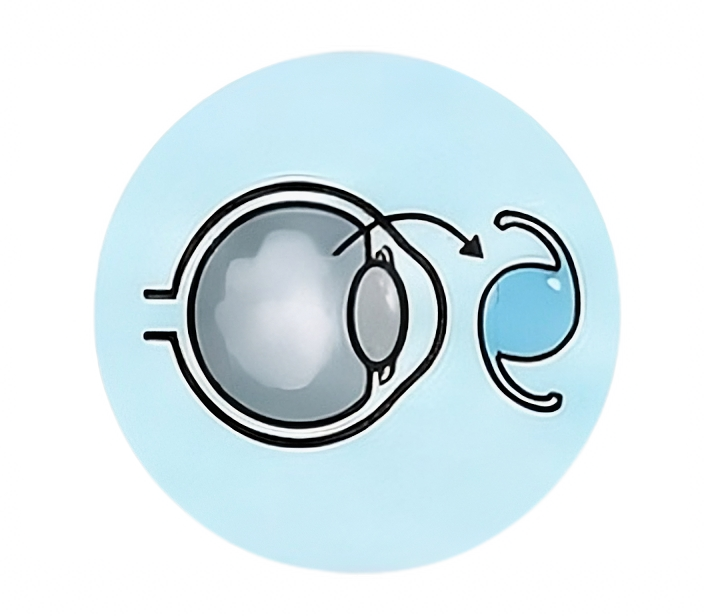 Cataract Surgery