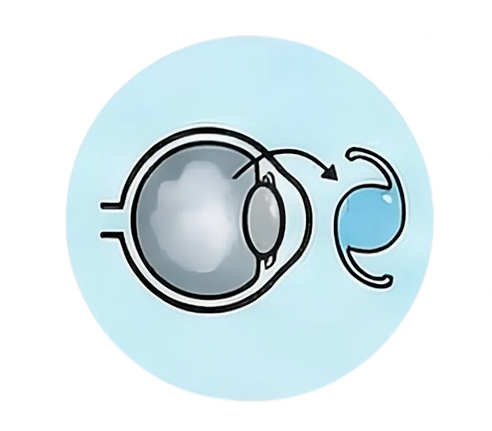 Cataract Surgery