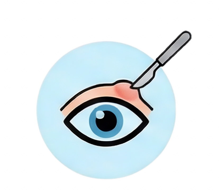 Chalazion Removal