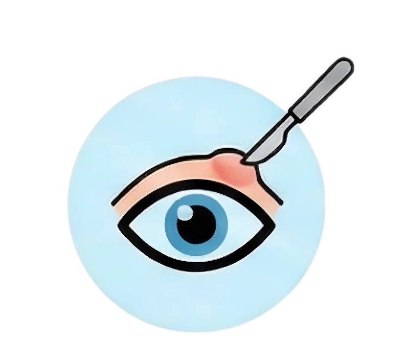 Chalazion Removal