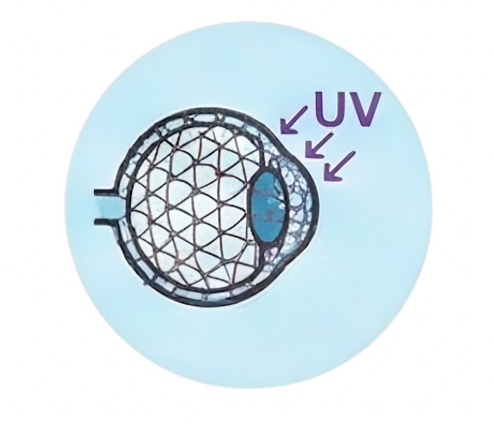 Corneal Crosslinking