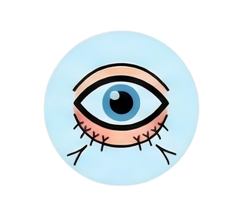 Ectropion & Entropion Repair