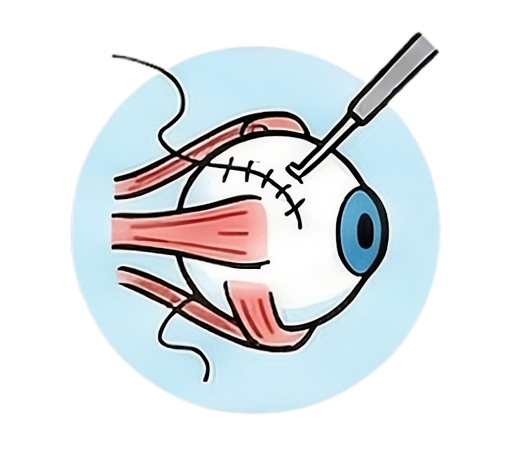 Eye Muscle Surgery