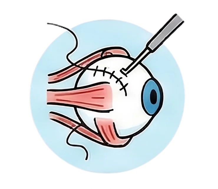 Eye Muscle Surgery
