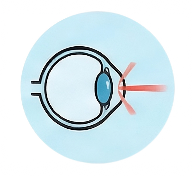 Refractive Surgery
