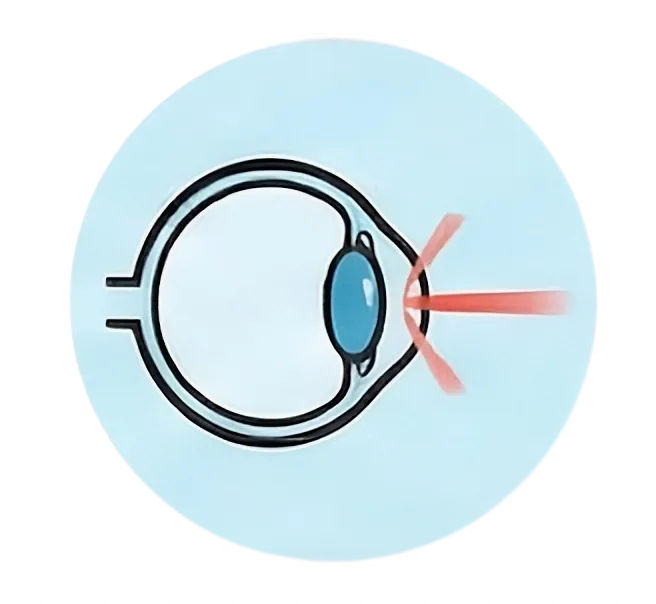 Refractive Surgery
